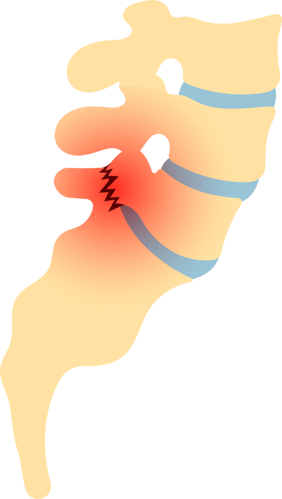 degenerative disc disease spondylolysis herniated bulging spondylosis spondylolisthesis arthritis spinal stenosis joint osteoporosis disk pain back lumbar cervical spine neck fusion osteoarthritis vertebrae bone sciatica